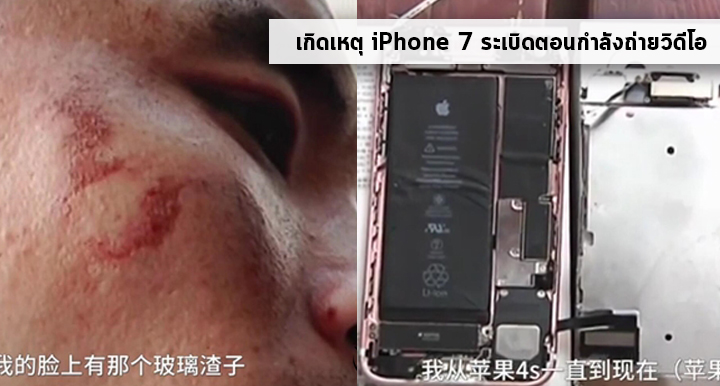 เอาบ้าง!! iPhone 7 ระเบิดใส่หน้าผู้ใช้งานขณะกำลังถ่ายวิดีโอจนได้รับบาดเจ็บ