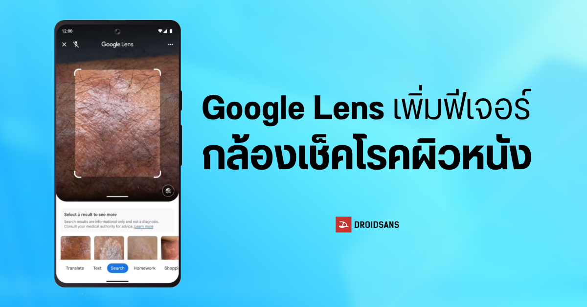 Google Lens เพิ่มสกิล ใช้กล้องส่องโรคผิวหนังเพื่อเช็คว่าเป็นอะไรกันแน่
