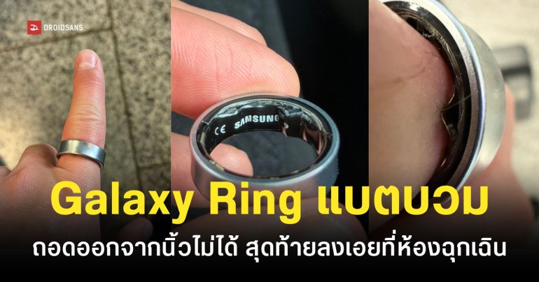Galaxy Ring แบตบวมคานิ้ว สุดท้ายต้องเข้าห้องฉุกเฉินให้หมอเอาออกให้